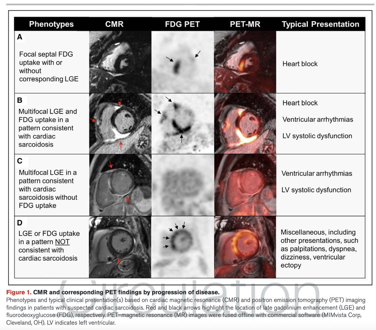 🧲 6/12: Cardiac MRI in CS: 1. Key diagnostic test 2. High sensitivity (95%) & specificity (85%) 3. Myocardial LGE predicts mortality & Ventricular Arrythmias 4. Common locations: LV subepicardial, septal, multifocal, RV free wall 5. No specific LGE patterns for diagnosis 📊