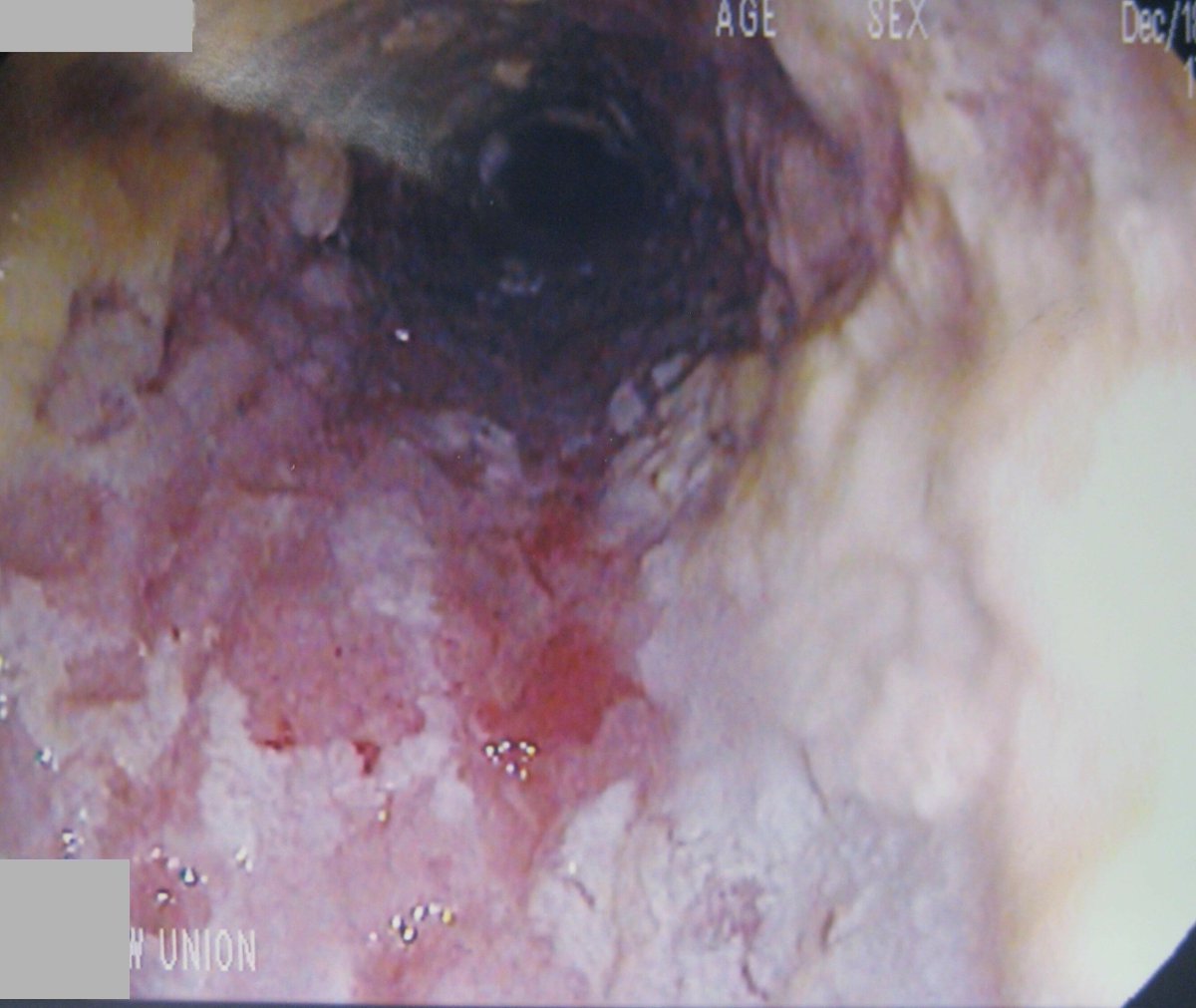 A 33-year-old noncompliant HIV patient with a CD4 count of 20 presents with dysphagia, odynophagia, and substernal chest pain. An upper endoscopy image is shown. What's the diagnosis?

1. HSV esophagitis
2. Candida esophagitis
3. CMV esophagitis
4. HPV esophagitis

If you like my…