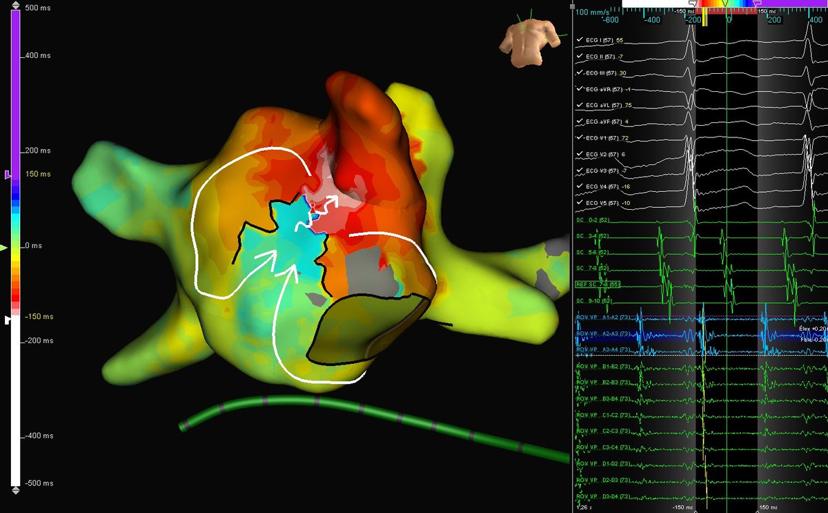 EPWaveDoc's tweet photo. Headshot ablation of symptomatic left atrial flutter with the first RF burn🔥in 62 yo patient w bioprosthetic mitral valve replacement. PPI = TCl from CS. Ablation by @RomainVergier map by @MathildeHrsn1 #superequipe @CHUM972 #Martinique #Epeeps #Cardiotwitter @Hapa_EP https://t.co/L4O7lmOPfZ
