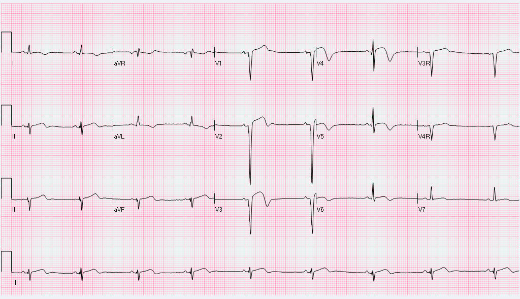 Chest pain and ST elevation, in sequence (a different case, age 5)