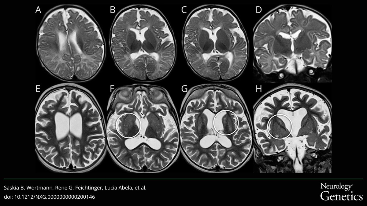 Clinical, Neuroimaging, and Metabolic Footprint of the Neurodevelopmental Disorder Caused by Monoallelic HK1 Variants: bit.ly/3UpXTrF

#NeuroGenetics #NeuroTwitter