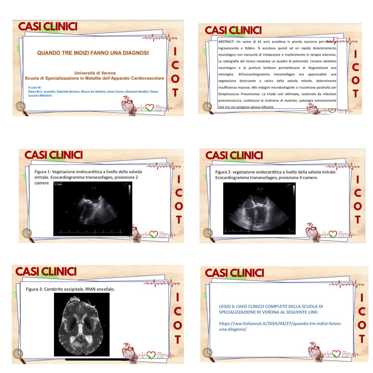 🫀🧠 ICOT consiglia: clinical case of the week 🫀🧠

💡QUANDO TRE INDIZI FANNO UNA DIAGNOSI💡

❗ Leggi il caso clinico
urly.it/3_hrz

#cardiology
 
#cardiologyfellow
 #cardiologia #endocarditis