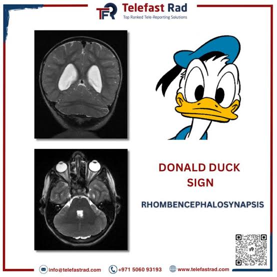 PeterItebimien's tweet photo. @IhabFathiSulima Rhombencephalosynapsis (RES)~donald duck sign 
It is a rare,congenital malformation of the posterior fossa characterized by hypogenesis or agenesis of the vermis,a dorsal fusion of cerebellar hemispheres,and fusion of dentate nuclei and superior cerebellar peduncles. https://t.co/lKJz1silvA