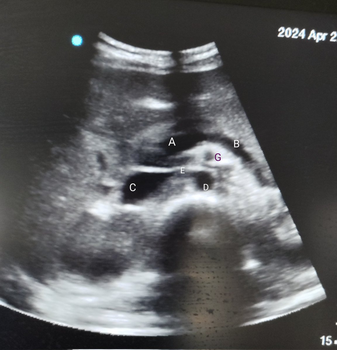 Abdominal ultrasound🫄
What are the labelled structures?
#MedTwitter
#MedX
#FOAMED
#POCUS
#GITWITTER