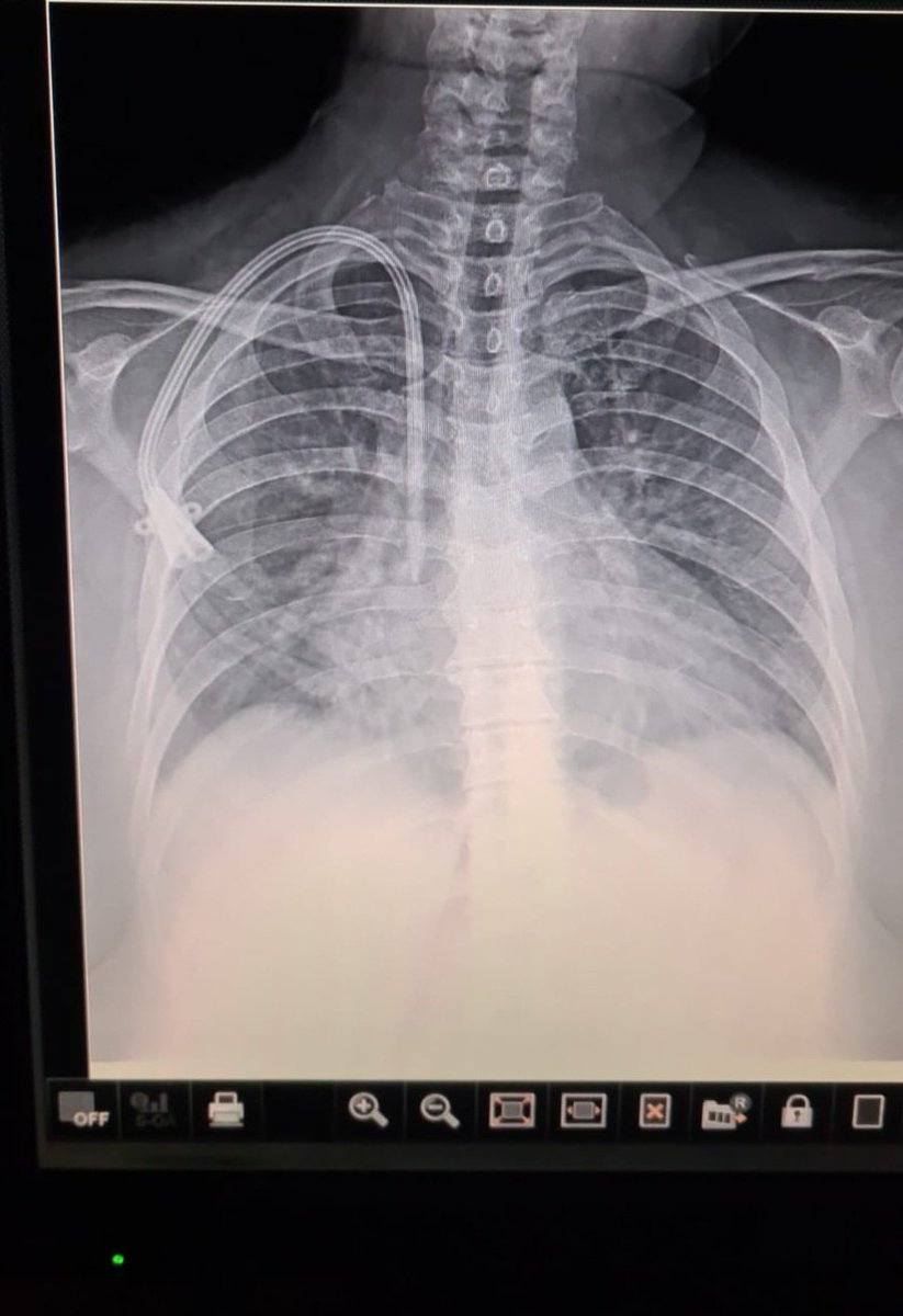 Vascular Tunneled Central Catheter Access

#interventionalnephrology #INfellow #esdeque #Nefrologia