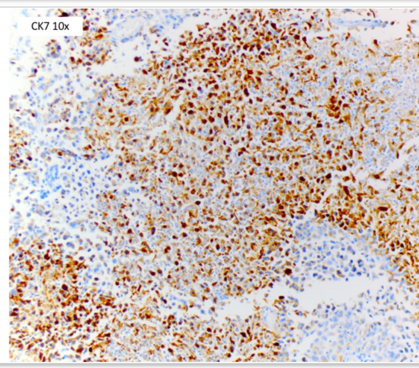 Interesting case

65 year old, brain mass

Dx?

@avash22 #neuropathology #pathology #cancer  #brain