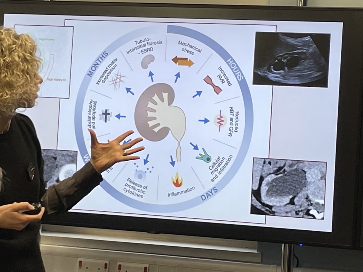 “The death of a kidney” ….such a fabulous talk by #susanwillis ⁦@GuysUrology⁩ Friday am meeting. Amazing standard every week this year. 1250 Fridays and still counting …😳😊