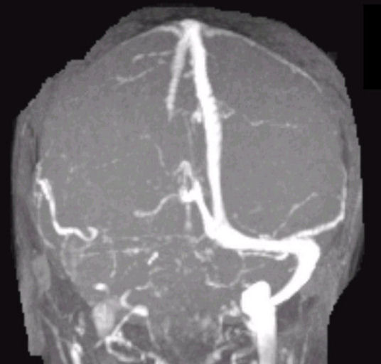 A 28year old postnatal patient presented with headache, decreased vision, vomiting and fits.
B/L Papilledema on Funduscopy.
What's your diagnosis!
#MedX #MedEd
