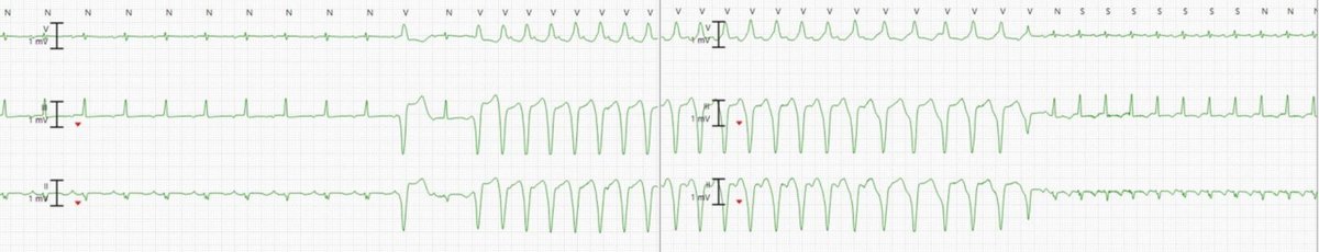 What's going on? 🤔

Will share interpretation shortly!

#Epeeps #CardioTwitter #ECG #Cardiology