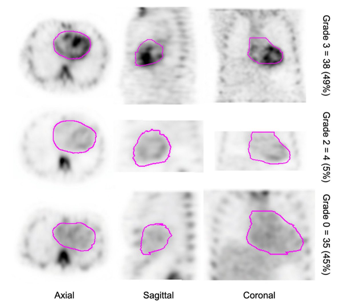 Deep learning approach for automated segmentation of myocardium using bone scintigraphy SPECT-CT in patients with suspected cardiac amyloidosis - @JNCjournal journalofnuclearcardiology.org/article/S1071-… @acepuba @maz_hanna @almallahmo @dianeavilamed @estelais @AmiloLATAM @MyASNC @alexsfelixecho