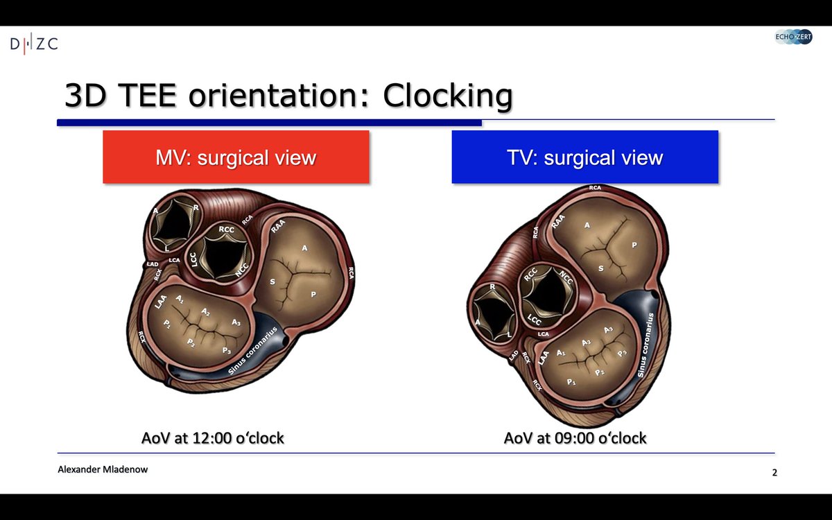 #echofirst 🫀the 👀see what the🧠 knows⤵️#CardioTwitter TV SURGICAL VIEW 👉AV at 🕘, TV septal leaflet at 🕕➡️also applies for TTE 🙏
