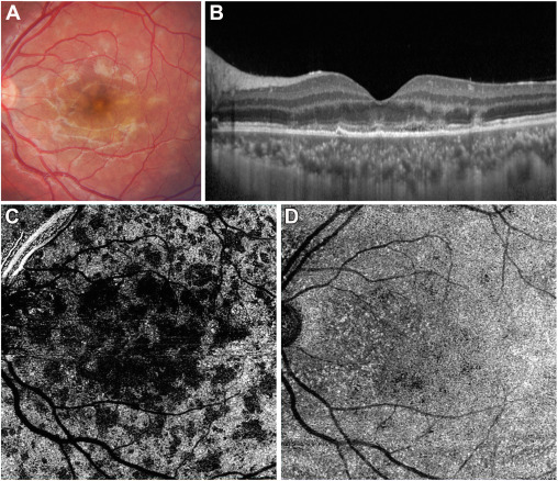 Ophthopedia Update: Choriocapillaris Recovery on OCT Angiography in Acute Posterior Multifocal Placoid Pigment Epitheliopathy dlvr.it/T6632m #Ophthalmology #ophthotwitter #eyecare