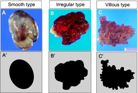 Morphologic Patterns of Excised Cardiac Myxoma 🔬❤️ #cardiacpath link.springer.com/article/10.100…