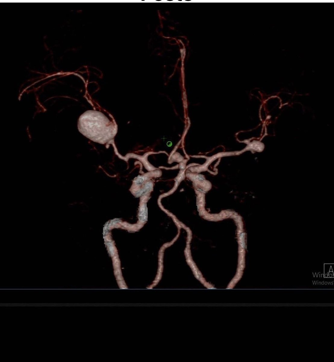 Thunderclap Worst Headache of Life: what are your next 5 moves?