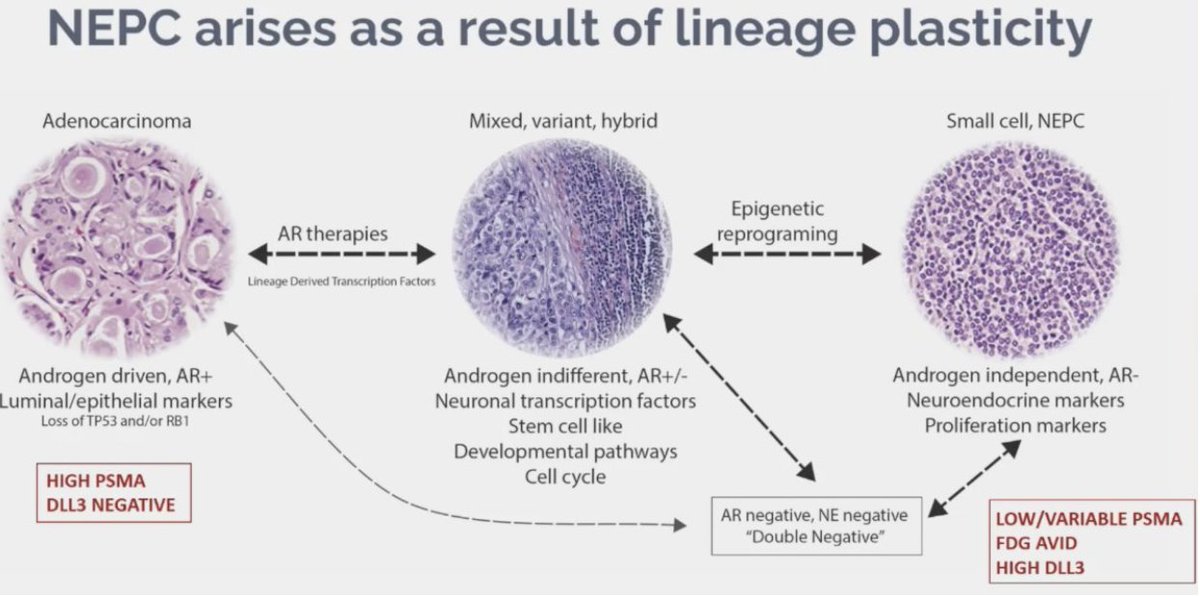 How to identify aggressive variant prostate cancer? Presented by Himisha Beltran, MD, @DanaFarber @harvardmed. #APCCC24 Written coverage by @RKSayyid @UofTUrology @ihpmeuoft. > bit.ly/4duXufl @APCCC_Lugano