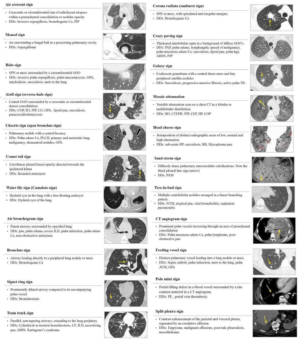 Some common cardiopulmonary signs 🫁 #radiology #medtwitter