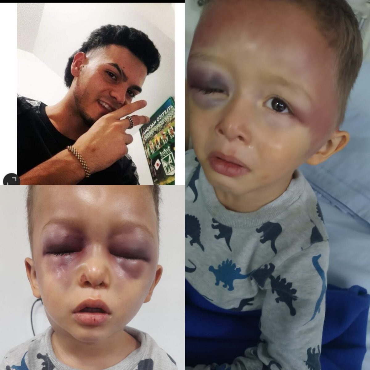 #noticias/ Necesito hacer público esto y que se haga justicia... El padrastro lo golpeó brutalmente por qué se orino en la cama, el tipo se hace llamar yanca y es de San Pablo itagui, en el momento el niño está con severo trauma cerebral y está internado en la león 13.