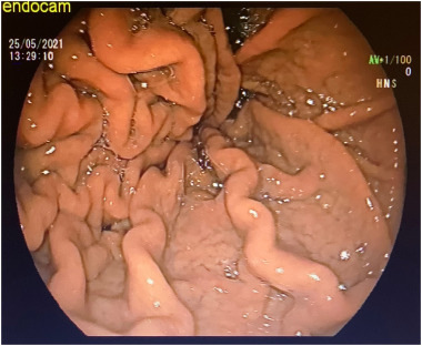 A 44-year-old man presents with anasarca and weight loss. Serum albumin is 1.6 g/dL. His upper endoscopy is shown below, notable for hypertrophy of gastric rugae. Diagnosis?

Learn more and generate your own board questions at
neuralconsult.com 🧠 🎯

Photo: see caption