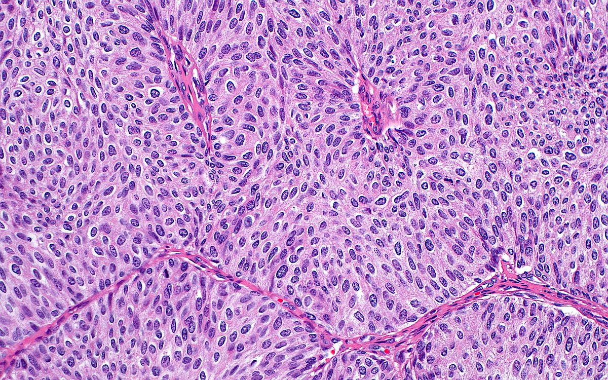 Papillary Urothelial Carcinoma ~ #GUpath
