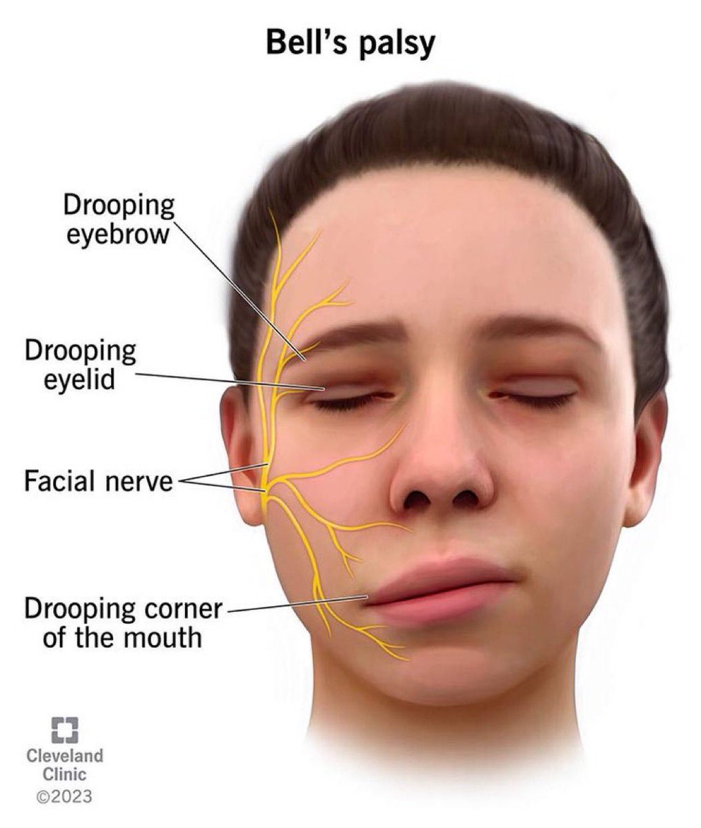 Bell’s palsy Yüz felci Tedavi edilmez ise kalıcı olabilir Önceden en sık nedeni soğuk maruziyeti/stres idi Şimdi en sık neden covid s$ıları s$ıperestler tebrikler ?!?!