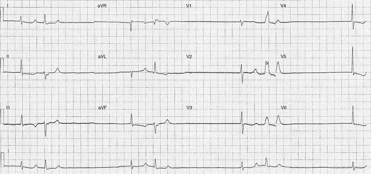 A 78 y/o male with a 2 day history of lethargy and dizziness. He has a history of ischaemic heart disease, type 2 DM, hypertension and chronic renal failure. - What’s your interpretation ? ➡️ Answer and Interpretation: manualofmedicine.com/ecgs/ecg-case-… #medtwitter #foamed #ecg #cardioed