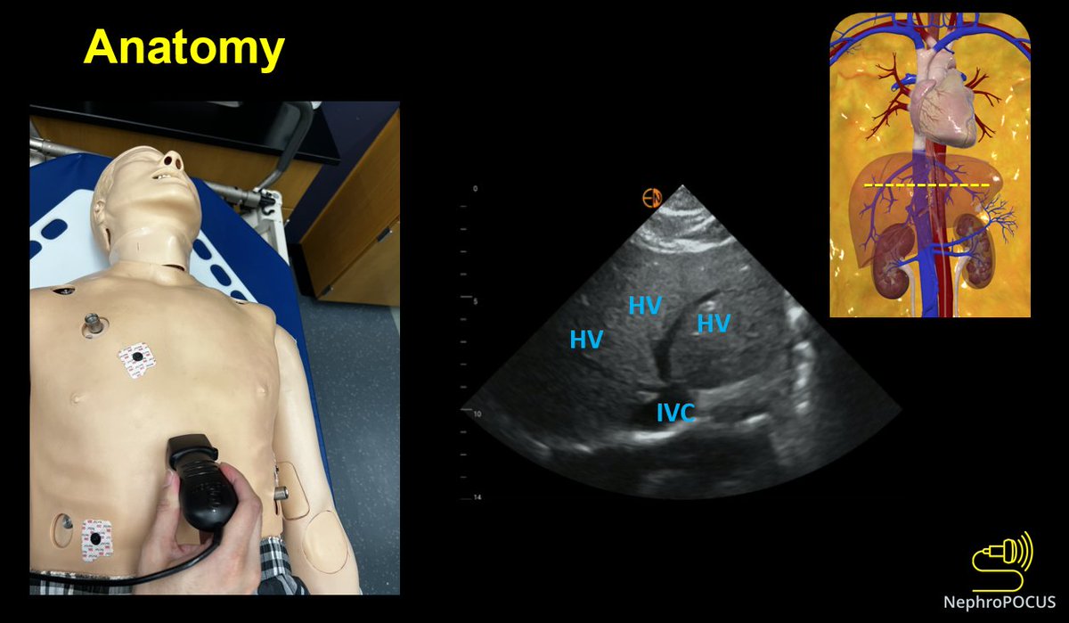 It's delightful to discuss #VExUS at the 3rd Nephro #criticalcare review course. Thanks to Dr. Tapas Kumar Sahoo and the team for extending the invitation and organizing this educational event. 
#Nephcrit #POCUS heralds the future!