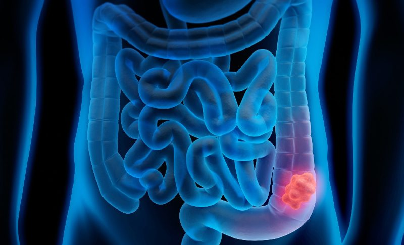 #ColonCancer, traditionally associated with older adults, is now increasingly affecting younger populations, raising concerns among #medicalprofessionals

#Health #HealthIssues #Cancer 

Have an understanding of this #dangerous issue!
indiaobservers.com/alarming-rise-…
