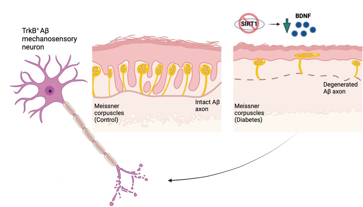 Diabetic neuropathy is often accompanied by mechanical allodynia. O’Brien et al. report that alterations in skin-derived factors contribute to allodynia, suggesting that it may be possible to develop topical treatments for diabetic neuropathy. tinyurl.com/5n82btcy