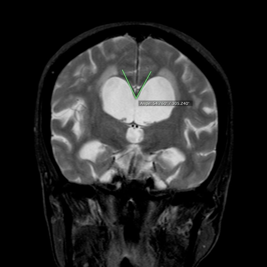Callosal angle as a radiological marker to distinguish Normal Pressure Hydrocephalus from Ex Vacuo Ventriculomegaly.

Normal: 100-120°
NPH: 50-80°

@AANSNeuro @The_SBNS @neurosurgatlas @TheJNS @neurosurgery @AOSpine

#MedTwitter #MedEd #Neurosurgery #Brain #Spine