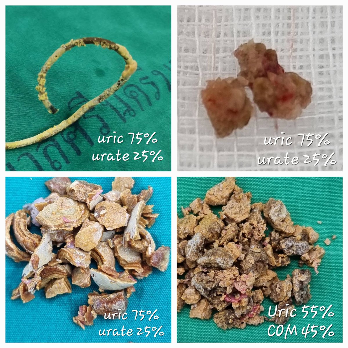 Urolithiasis
#stoneanalysis