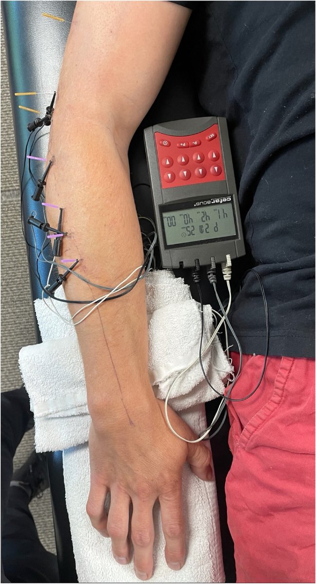 Percutaneous tendon dry needling and thrust manipulation as an adjunct to multimodal physical therapy in patients with lateral elbow tendinopathy: A multicenter randomized clinical trial pubmed.ncbi.nlm.nih.gov/38676324/