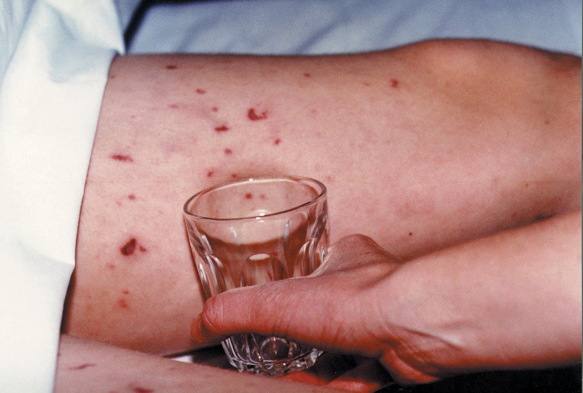 A #rash that does not fade under pressure can be a sign of #meningococcal #septicaemia. The glass test is a useful way to test for this 👍 However, a rash may appear late or not at all, so it's important to know all symptoms of #meningitis 👉 bit.ly/2b8Ek14