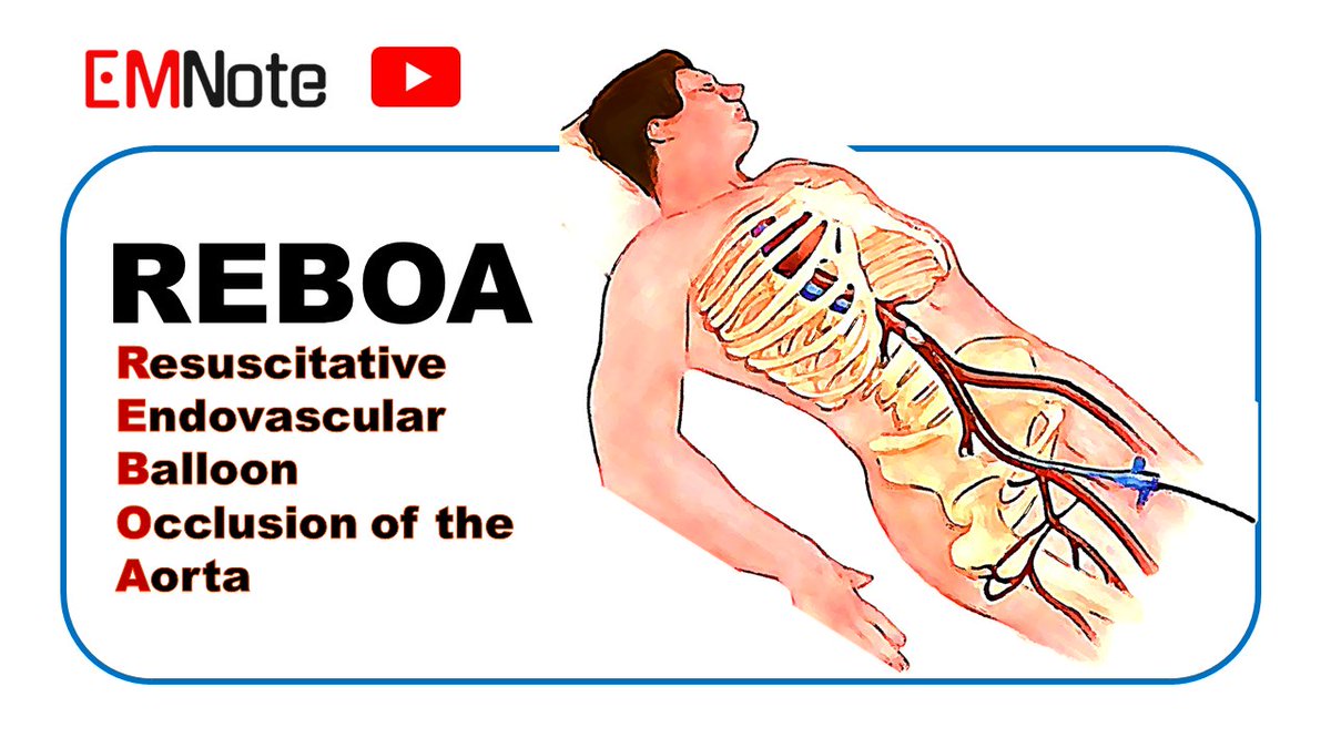 REBOA: What, Why, and How? youtu.be/HiHBy8yXmYc&li…