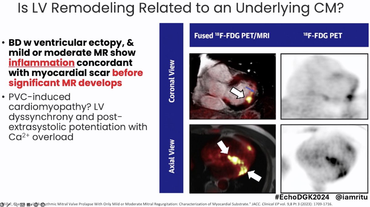 Why bother about distinguishing Barlow mitral valve disease or FED? A brilliant lecture given by @iamritu at #EchoDGK2024 satellite symposium organized @AHagendorff #echofirst @eromerodorta @denisamuraru With crucial points: ✅ barlow and FED are totally different diseases, not…