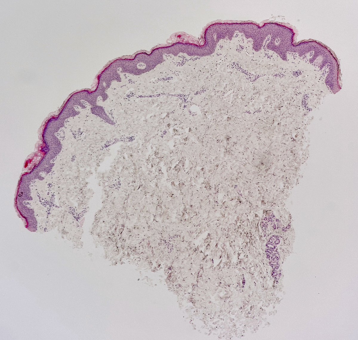 MBBS_Pathology's tweet photo. Today’s case for learning #Dermpath 
A potentially #InvisibleDermatosis
This 1 #Dermatophyte infection 
📸 1 Only slight hyperkeratosis + few PV lymphocytes 
📸 2+3 #Fungus in stratum corneum 
Not always easy to 👀
📸 4 Always do PAS
#pathology 
#dermatology 
@NeganLedger 
🤓😉 https://t.co/QIanz7a3jJ