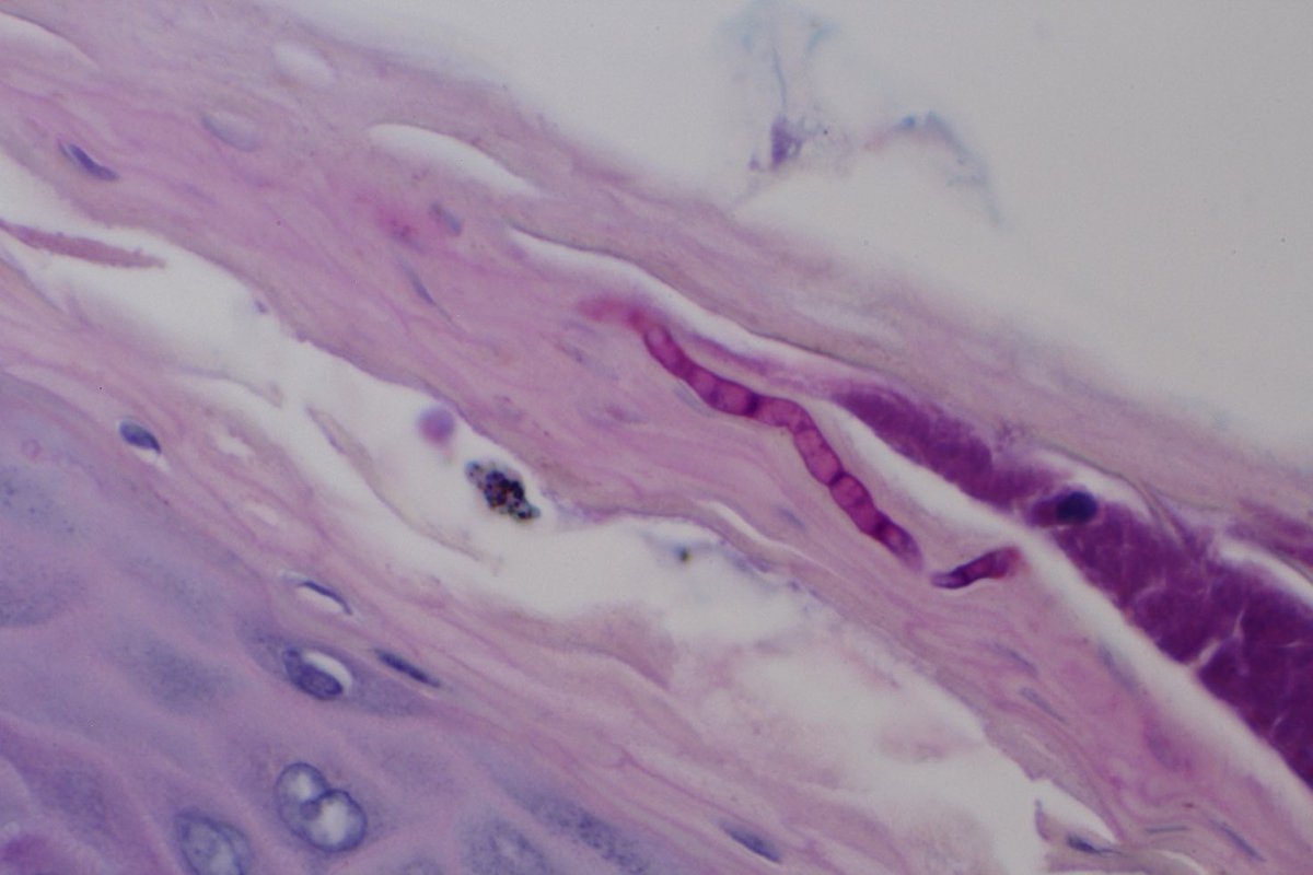 MBBS_Pathology's tweet photo. Today’s case for learning #Dermpath 
A potentially #InvisibleDermatosis
This 1 #Dermatophyte infection 
📸 1 Only slight hyperkeratosis + few PV lymphocytes 
📸 2+3 #Fungus in stratum corneum 
Not always easy to 👀
📸 4 Always do PAS
#pathology 
#dermatology 
@NeganLedger 
🤓😉 https://t.co/QIanz7a3jJ