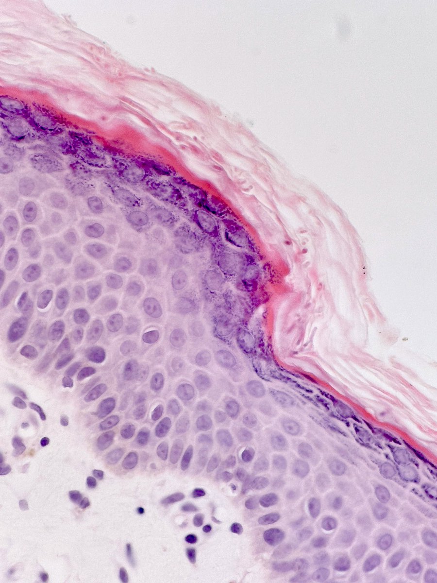 MBBS_Pathology's tweet photo. Today’s case for learning #Dermpath 
A potentially #InvisibleDermatosis
This 1 #Dermatophyte infection 
📸 1 Only slight hyperkeratosis + few PV lymphocytes 
📸 2+3 #Fungus in stratum corneum 
Not always easy to 👀
📸 4 Always do PAS
#pathology 
#dermatology 
@NeganLedger 
🤓😉 https://t.co/QIanz7a3jJ