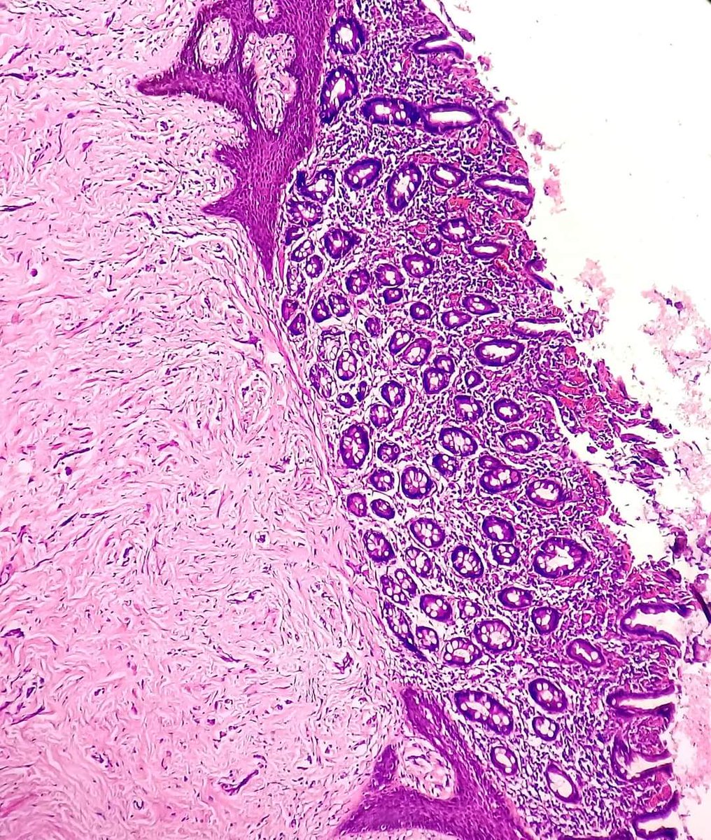 Omphalomesenteric duct(Vitellointestinal duct) remnant presenting as a rubbery skin nodule at the umbilicus of 2 years old child.
#dermpath #dermatology #embryology