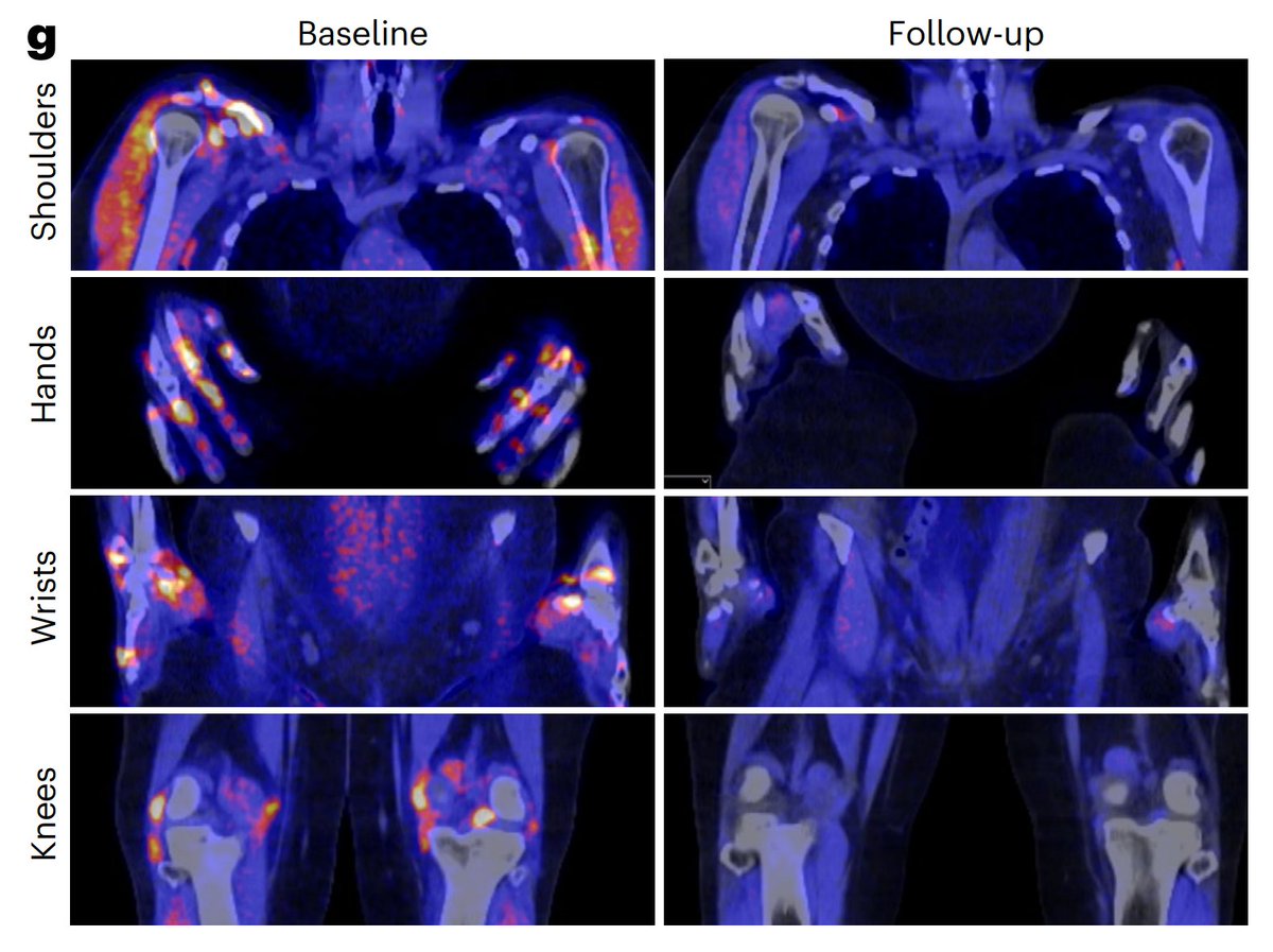 Bispecific T cell engagers (BiTEs) recruit T cells to target cells - usually B cells, in cancer - to deplete the targets

This study repurposed BiTEs for rheumatoid arthritis, an autoimmune condition driven by B cells

It's a small, single arm study of 6 patients, who had…