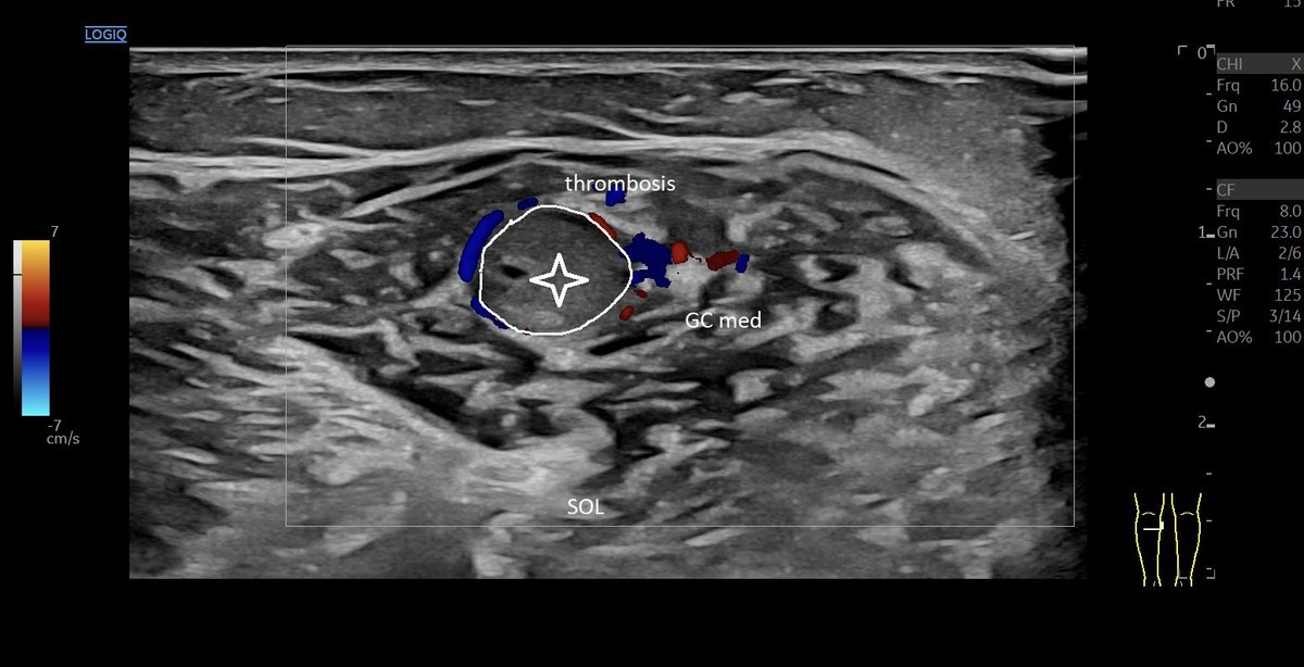 Intramuscular thrombosis after #muscleinjury of the m gastrocnemius caput mediale / Tennis 🎾 leg leaping into the v poplitea in #mskus #pocus #pocushub #GElogiqE10r3 #tennisleg #thrombosis #thrombose