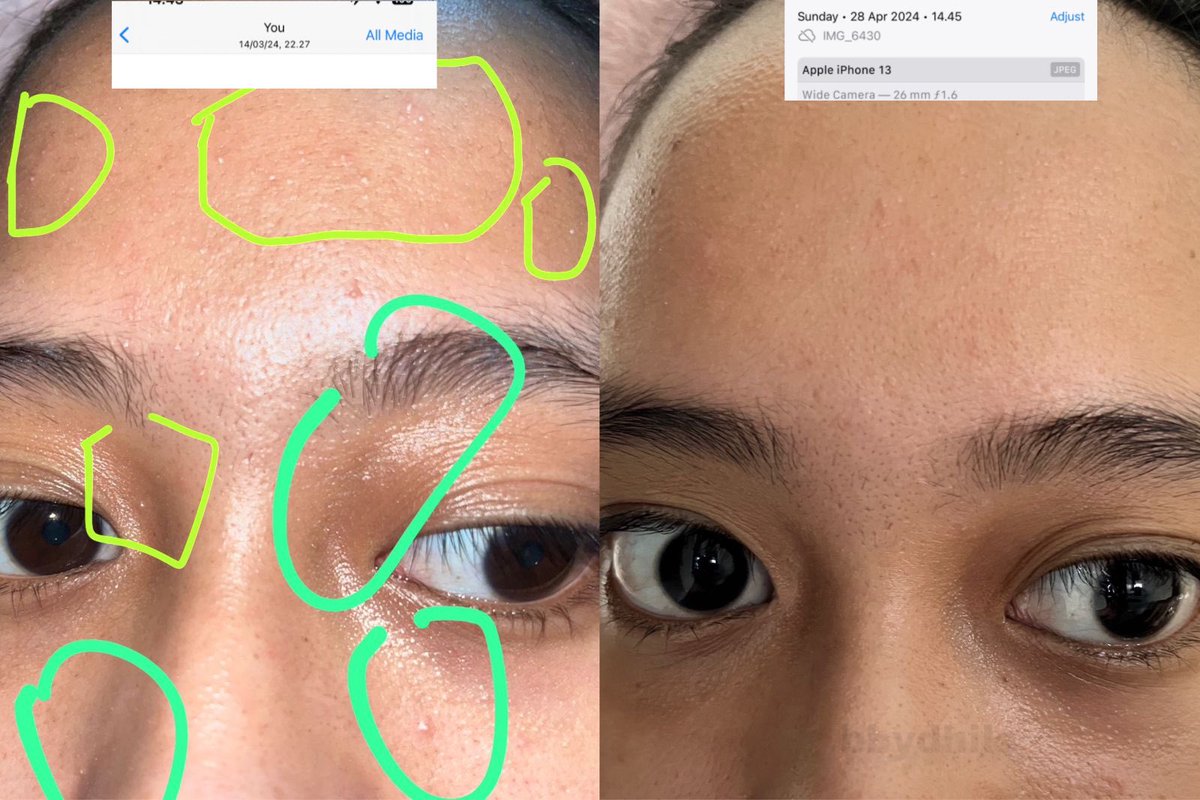 bbydhils_'s tweet photo. Siapa yang belum rajin exfoliasi????

Ternyata exfoliasi sepenting itu😰🫵🏻

Bisa di zoom mukaku di bulan maret bruntusan parah, whiteheads muncul semua. Akhirnya aku mulai exfoliasi dan alhamdulillah better🥹

#itsmybase #BASEExfoliatingPads https://t.co/xtAbWdBAgP