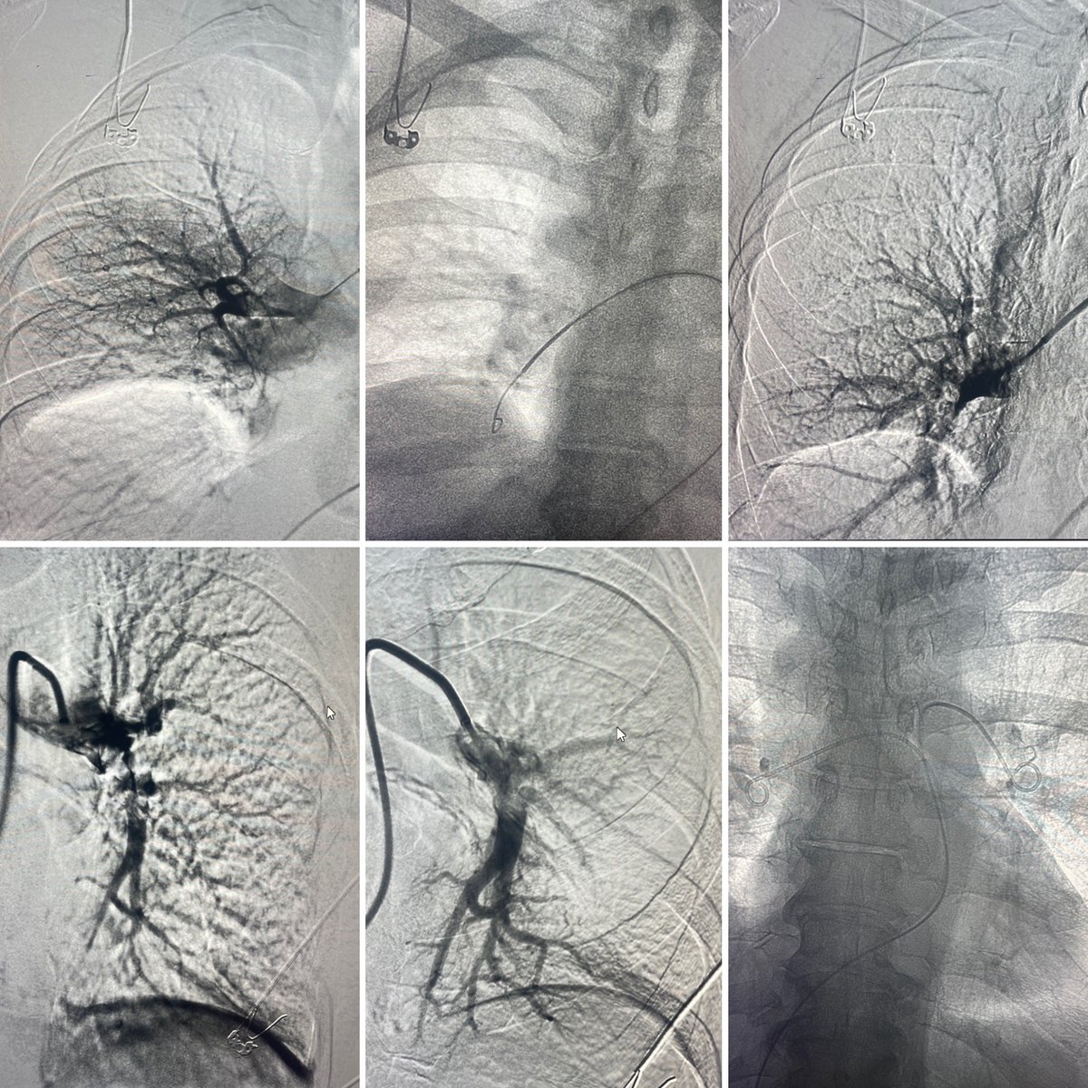 Suction thrombectomy using penumbra Cat8 indigo @penumbrainc followed by catheter directed Thrombolysis  for life threatening acute pulmonary embolism. Off O2 support next day. #PE #pulmonaryembolism #drdharav #IR #interventionalradiologist  #mumbai