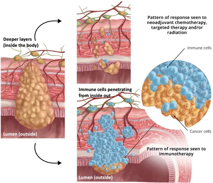 Response assessment crudely telling regression%🔢 is missing the bigger picture for patients receiving immunotherapy. 💡Time to revise assessment methods to reflect the pattern👇🏾. Different implications for the same response on chemo☢️🆚 immunotherapy. 📌nature.com/articles/s4138…