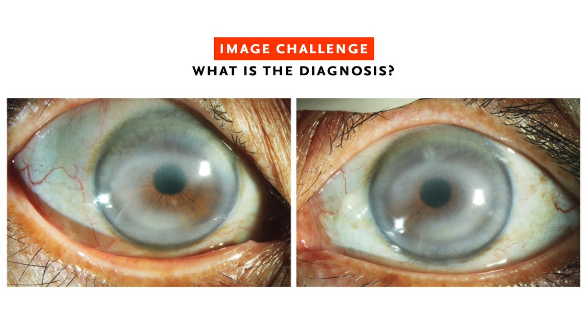 A 63-year-old woman who had presented to the ophthalmology clinic for evaluation of cataracts was found to have white-yellow rings in both eyes. Read the full case details and submit your answer or see how others responded: nej.md/IC04252024