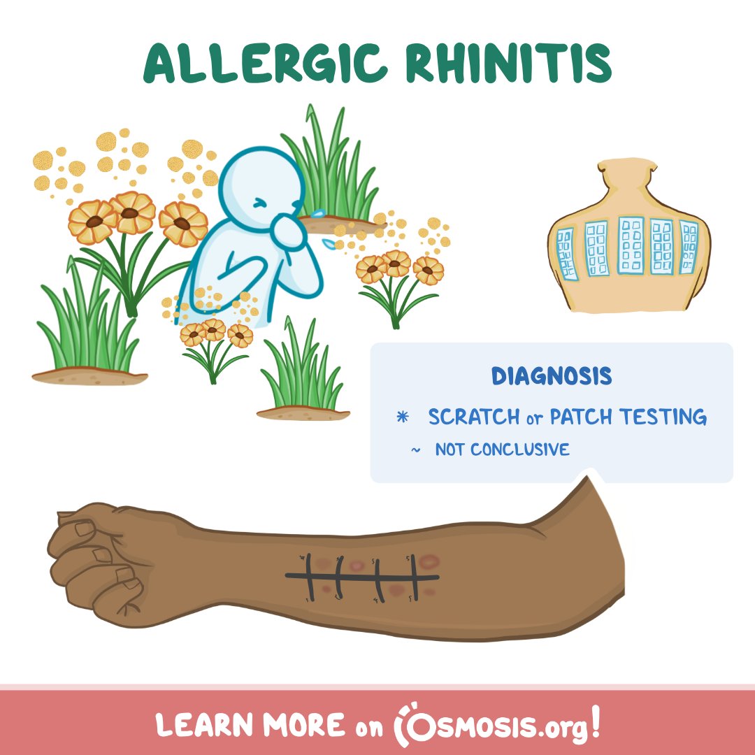 Today's #ClinicalPearl is about diagnosing #AllergicRhinitis with a skin patch test, in which allergens are applied to small patches and stuck onto the skin. Learn more: osms.it/cp-allergies-tw #LearnByOsmosis