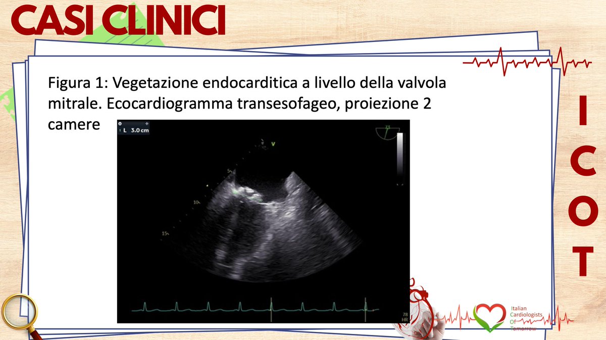 -ICOT Clinical case of the week 💡🫀 QUANDO TRE INDIZI FANNO UNA DIAGNOSI🫀 🫀A cura di: Elena M.S. Jannello 1 , Gabriele Bertani 1 , Marco De Stefano 1 , Anna Carrer 1 , Giovanni Benfari 1 , Flavio LucianoRibichini 1 Università di Verona urly.it/3_hrz