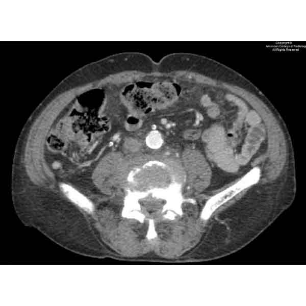 A 59-year-old man with previous trauma to the lower lumbar region from a motor vehicle accident presents with lower back pain. #ACRCaseinPoint bit.ly/3U2sThv