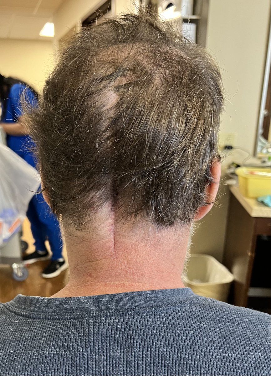 This scar is from an incision that was made in the back of my head during a covid jab induced emergency craniectomy, it allowed my brain to swell without damaging my brain stem. The incision went through my neck muscles which is part of the reason I can’t pilot an aircraft again.…