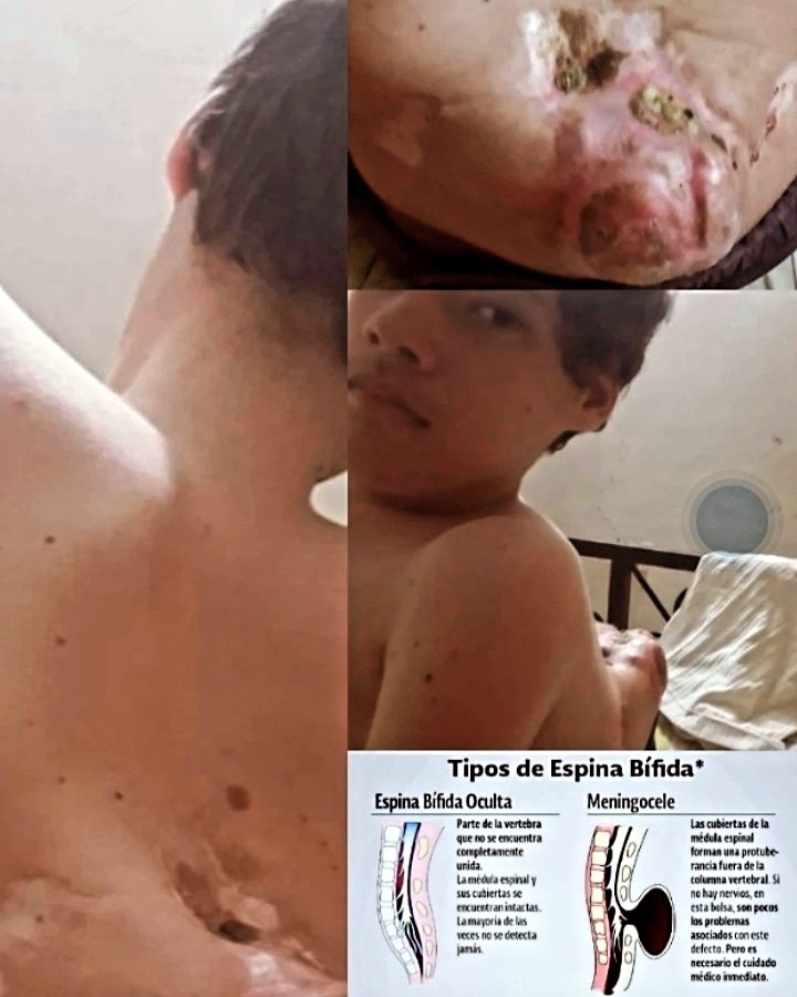 Ayuda a un joven Zuliano con condiciones especiales, displasia de las caderas, mielomeningocele, espina bífida, vejiga neurogénica, hidrocefalia. PAGO MÓVIL BDV 12622918 04246663432 . ZELLE Cuenta prestada inf DM, requiero de apoyo económico para costear gastos.