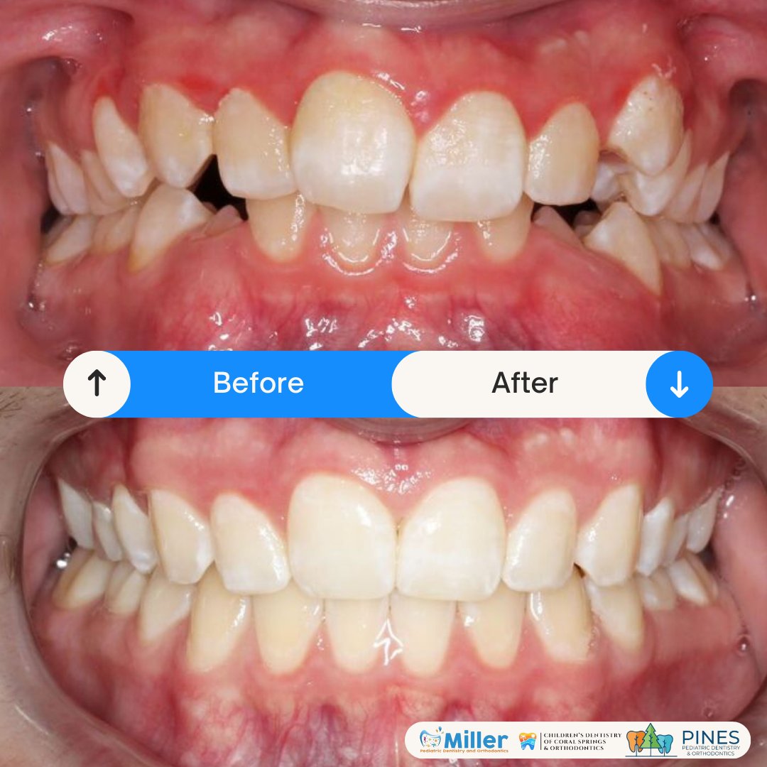 From wow to WOW! Witness the incredible transformation achieved by Dr. Kallis and our team. Ready to unlock your smile's full potential? Let's create magic together! 😁✨ #SmileTransformation #Orthodontics #Orthodontist #Invisalign #Braces #BoyntonBeach